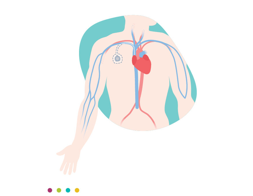 Chambre implantable Port-A-Cath