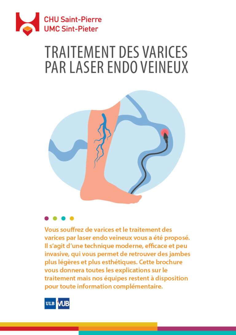 Traitement des varices par laser endo veineux