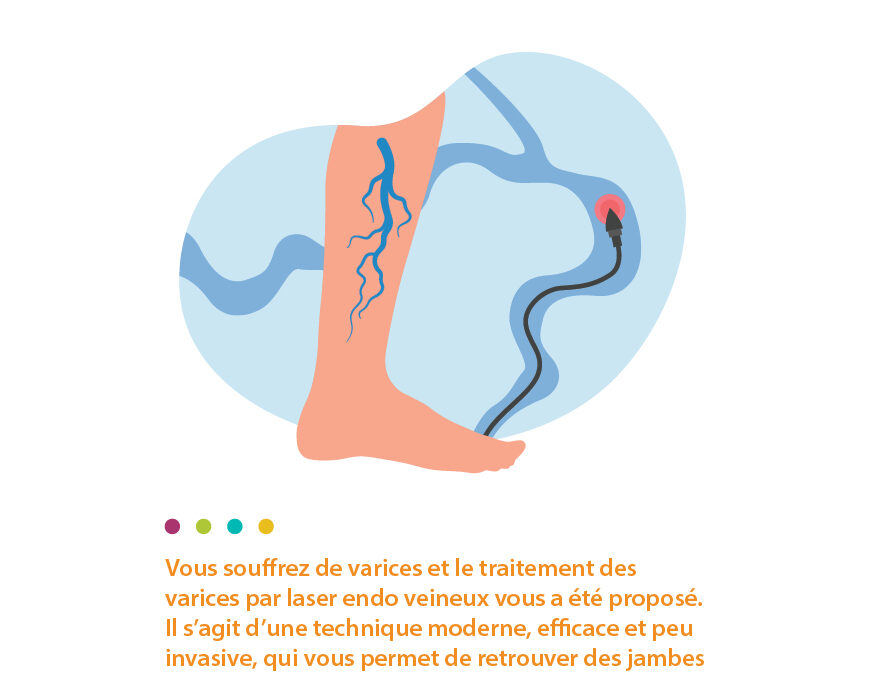 Traitement des varices par laser endo veineux