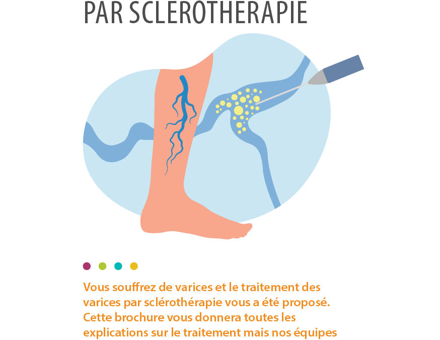 Varices Sclérothérapie